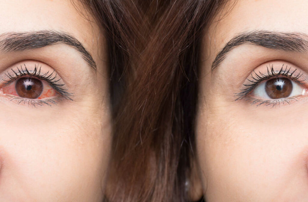 Reflecting side by side of a woman's face showing a dry irritated eye on the left and a normal eye on the right.