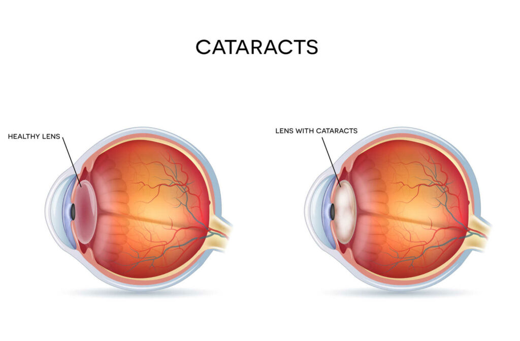 Illustration of a healthy eye with labeled components including cornea, iris, lens, and optic nerve, highlighting the presence of cataracts in the lens.