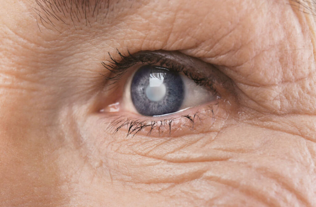 Up close photo of a cataract in an older woman's left eye.