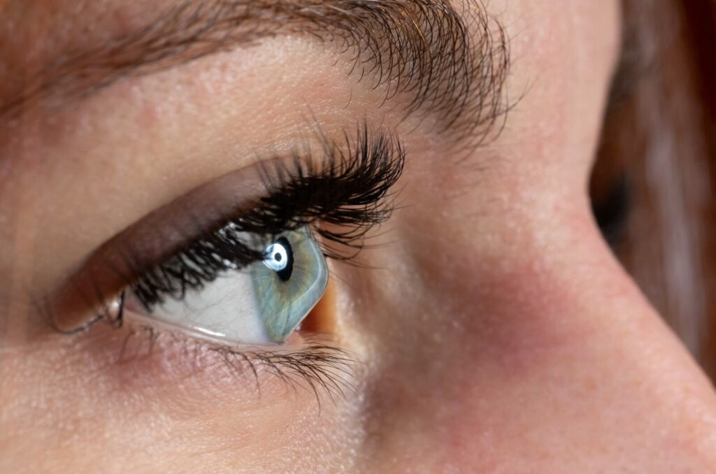 A close up view of a woman's right eye showing the bulging cornea typical of keratoconus.